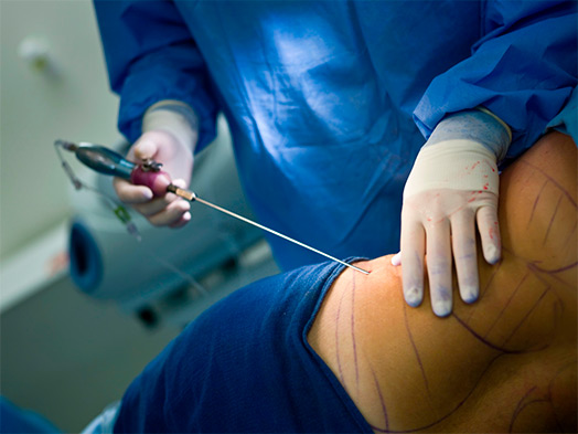 Lipoaspiración