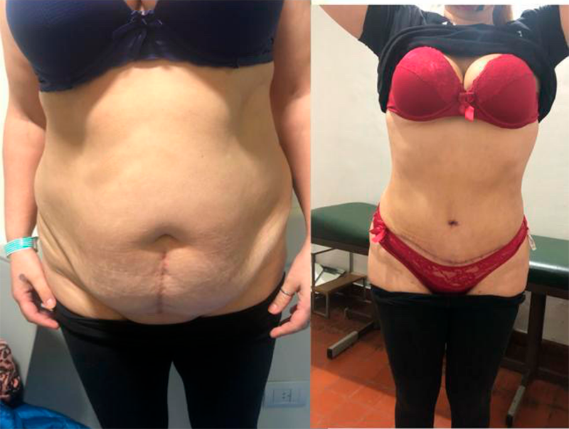 Mastopexia con implante de protesis mamario