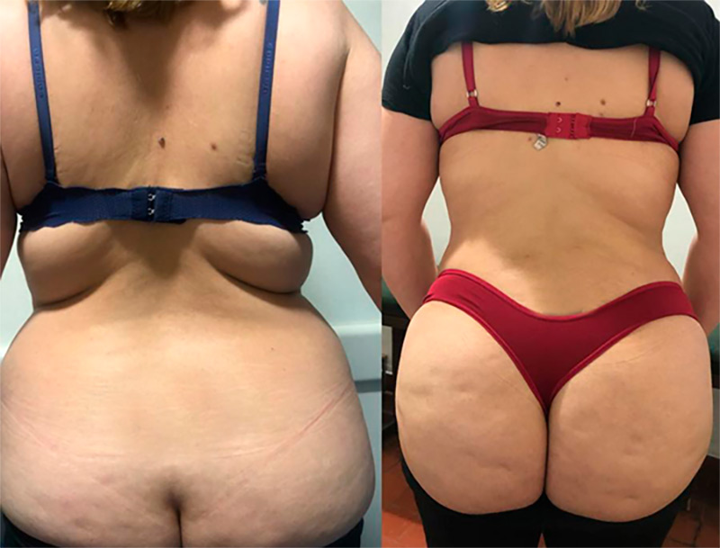 Mastopexia con implante de protesis mamario