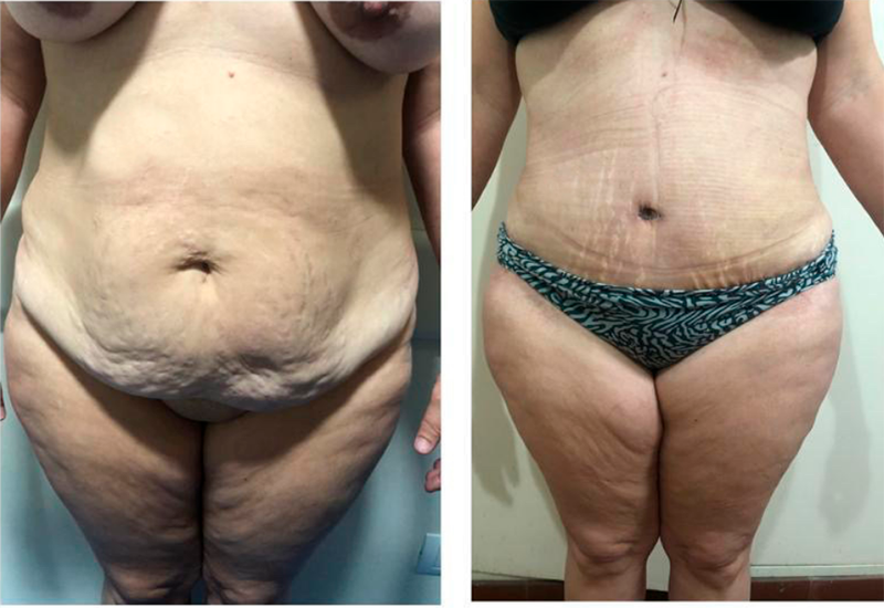 Mastopexia con implante de protesis mamario