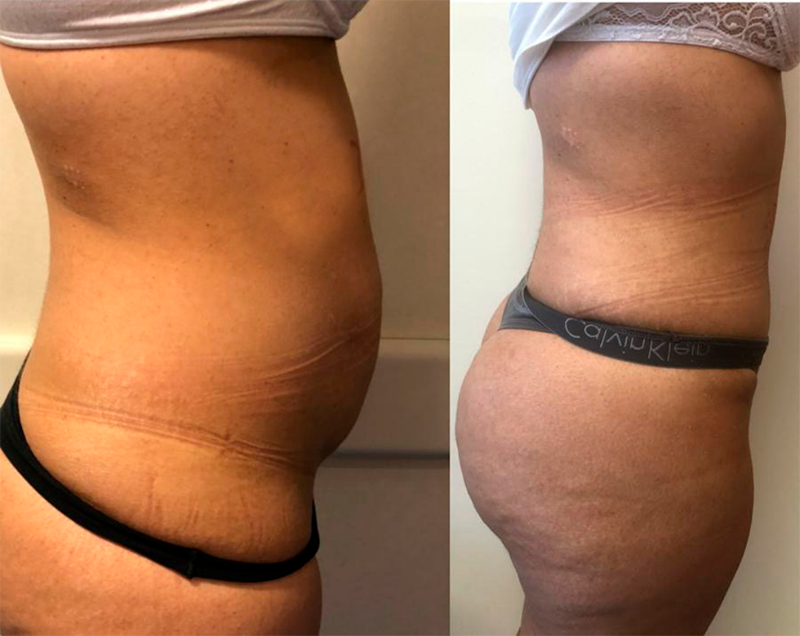 Mastopexia con implante de protesis mamario