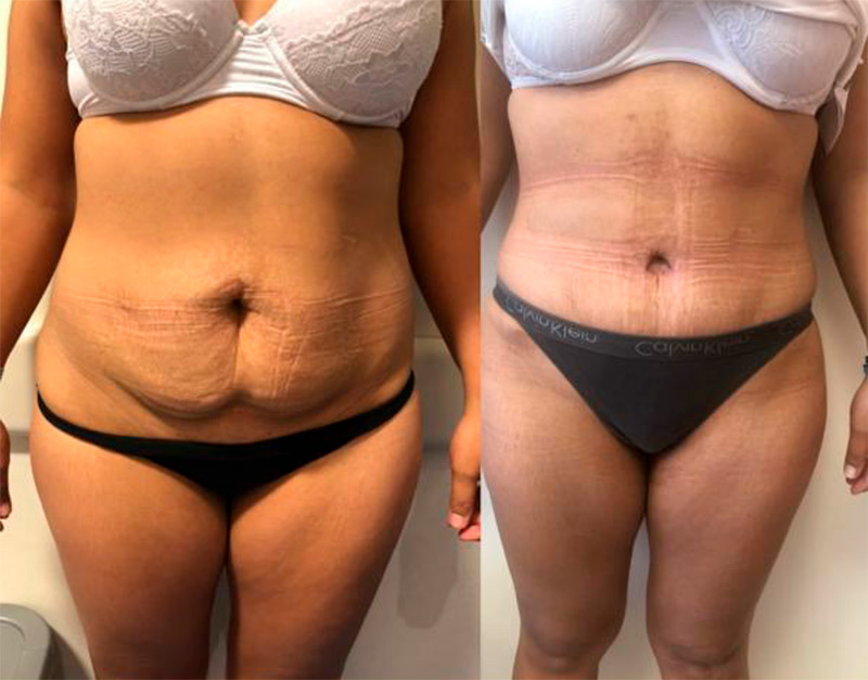 Mastopexia con implante de protesis mamario