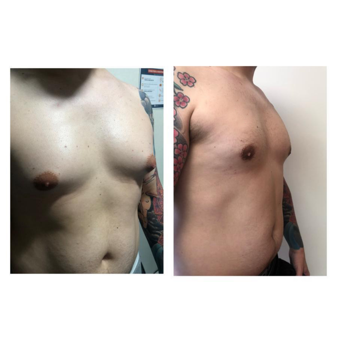 Mastopexia con implante de protesis mamario