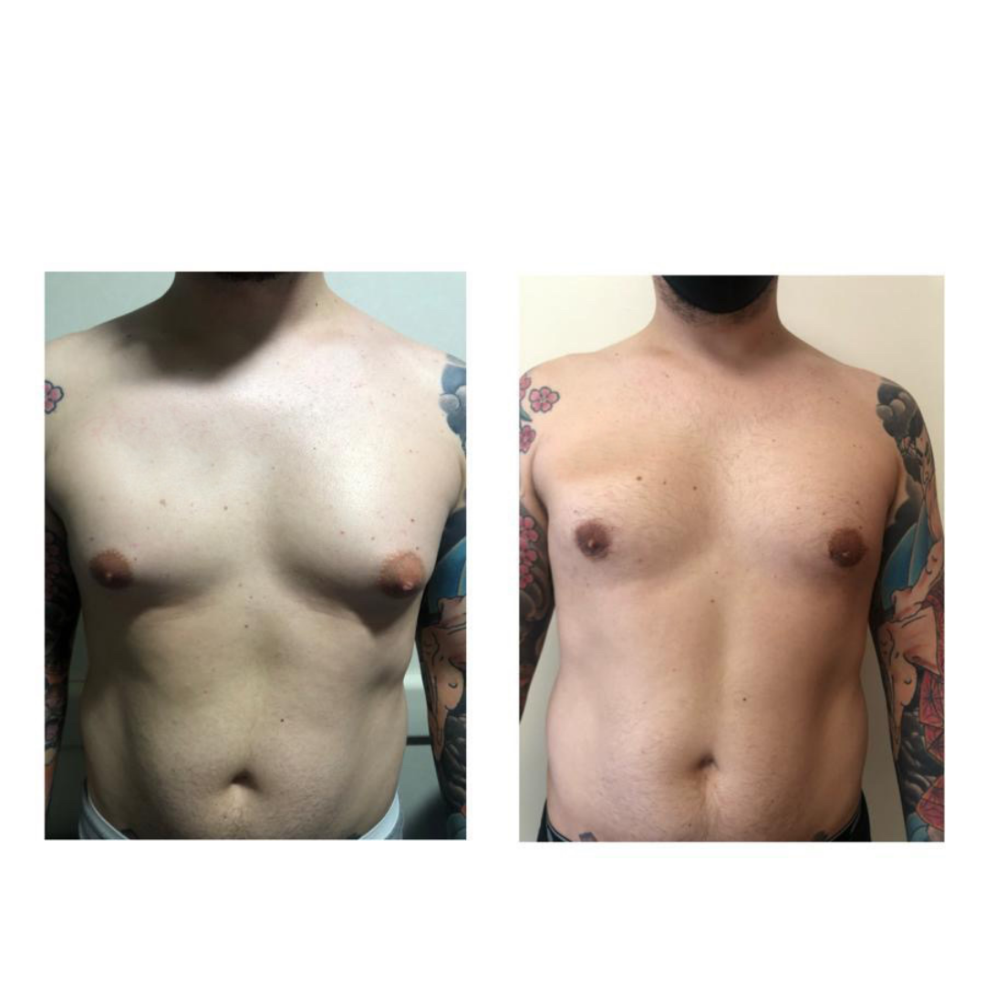 Mastopexia con implante de protesis mamario