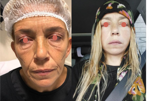 Mastopexia con implante de protesis mamario