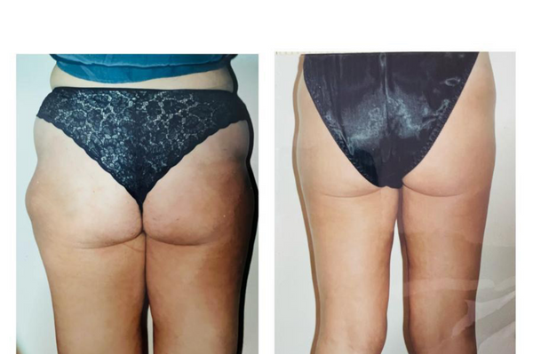 Lipoaspiración