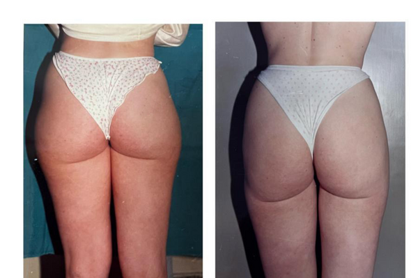 Lipoaspiración