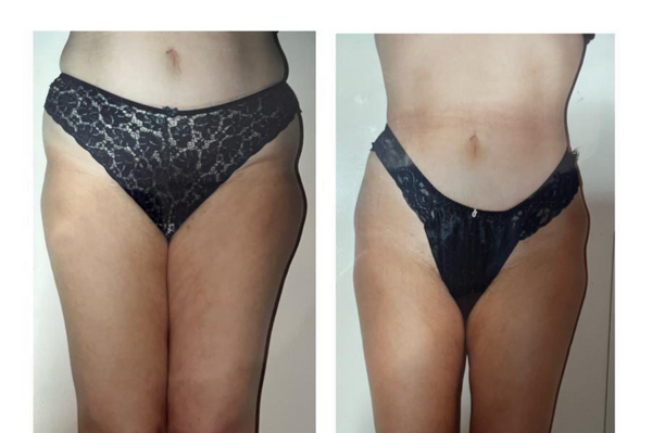 Lipoaspiración