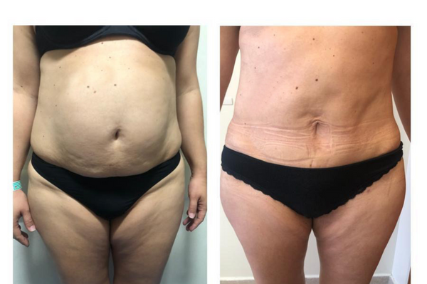 Lipoaspiración